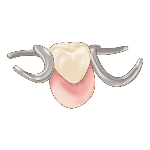 部分入れ歯